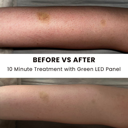 Before and after comparison of a leg treatment with a green LED panel.