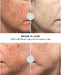Before and after comparison of skin treatment using a VISO LED Mask.