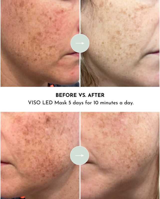 Before and after comparison of skin treatment using a VISO LED Mask.